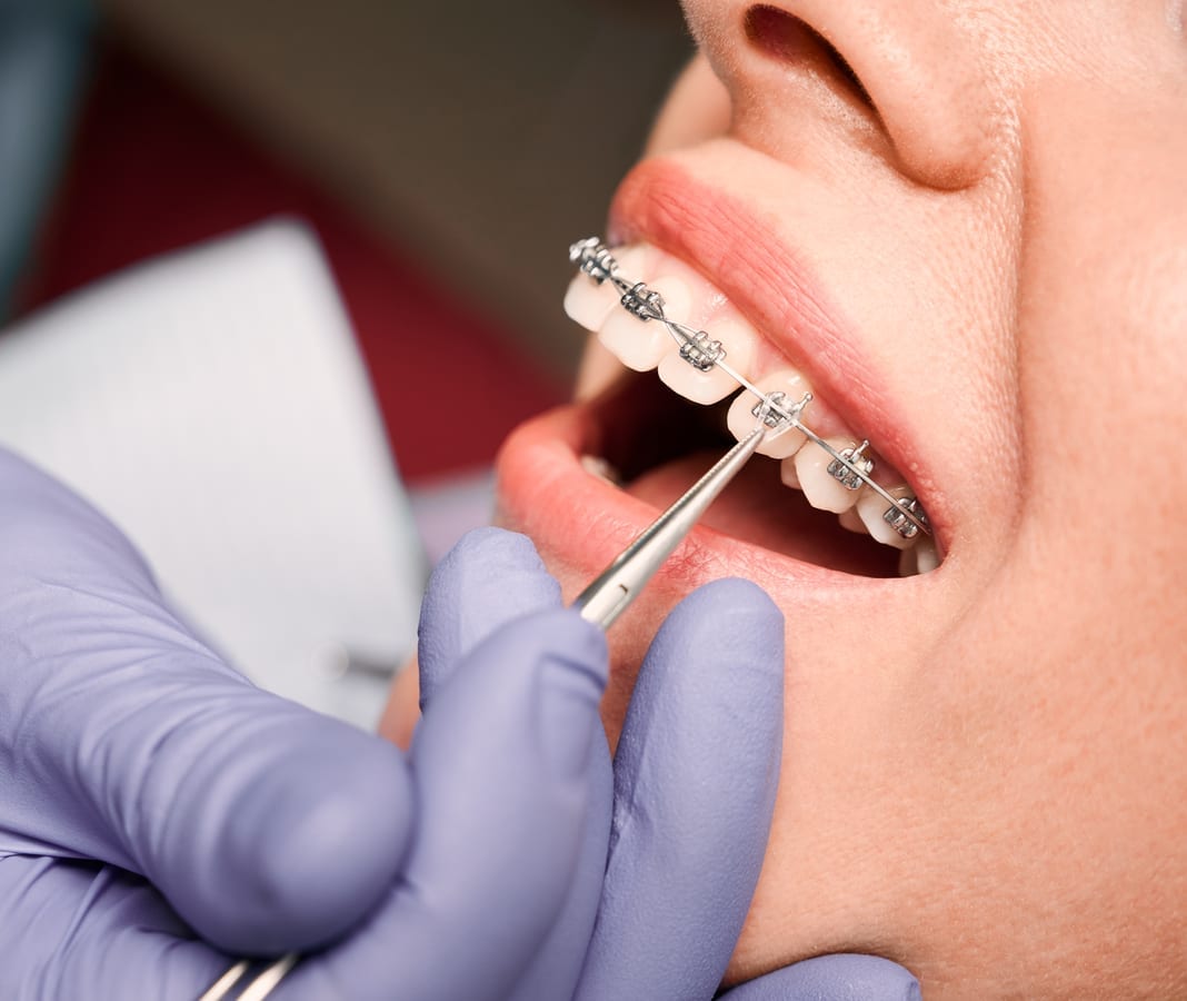Veneers treatment at Able Dental Dental